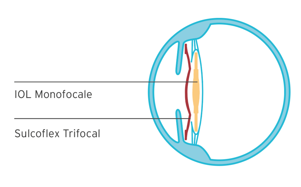 Sulcoflex Trifocal® Rayner 